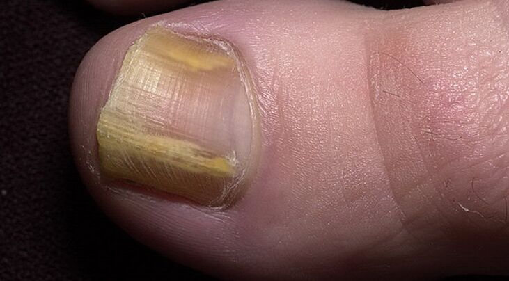 uszkodzenie paznokcia z infekcją grzybiczą