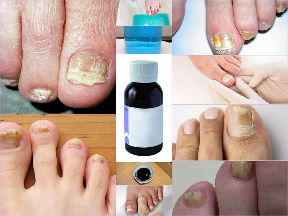 leki na grzybicę paznokci