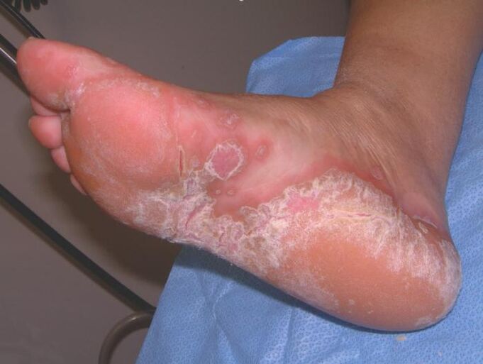 Stopa dotknięta infekcją grzybiczą