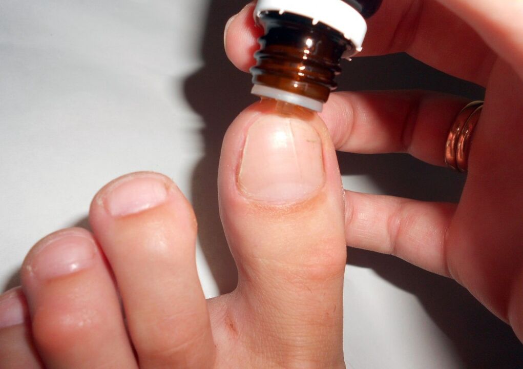 aplikacja kropli do leczenia grzybicy paznokci