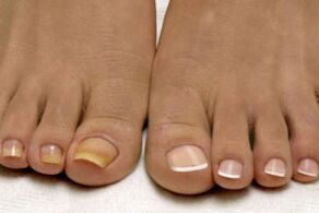 stopy przed i po leczeniu grzybicy paznokci