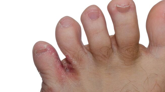 Objawy grzyba między palcami - pęknięcia i łuszczenie się skóry