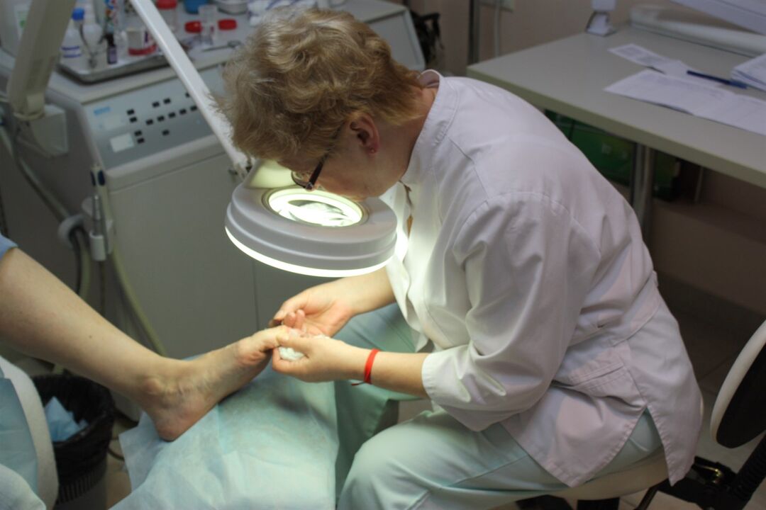 Imponujący rozwój grzybicy paznokci wymaga pomocy chirurga