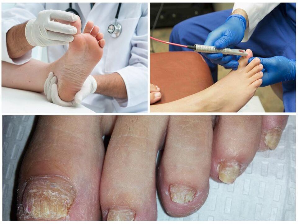 Lekarz diagnozuje i leczy paznokcie dotknięte infekcją grzybiczą. 