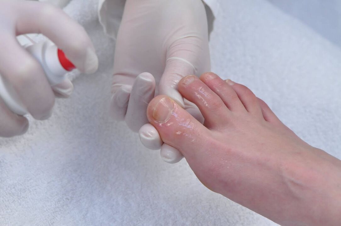 Początkowy etap grzybicy paznokci jest powodem do poddania się badaniom diagnostycznym u dermatologa